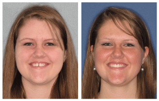 Before and After Treatment66