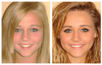 Before and After Treatment1