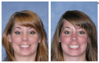 Before and After Treatment