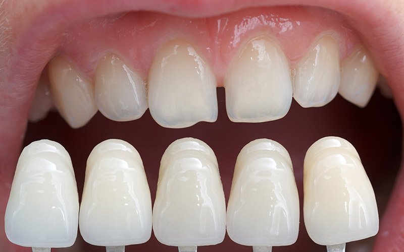Cosmetics Crowns & Bridges