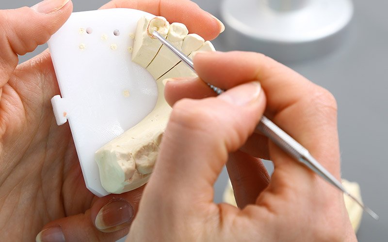 Fluoride Treatment