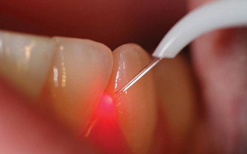 LANAP partial dentures