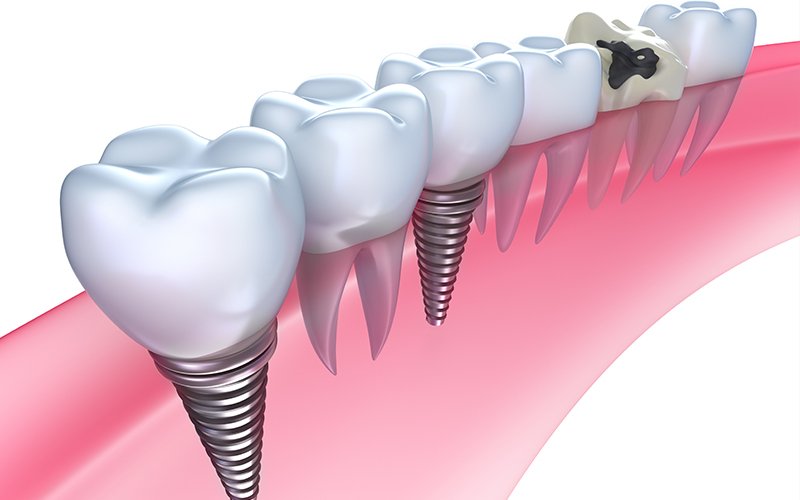 Types of Dental Implants