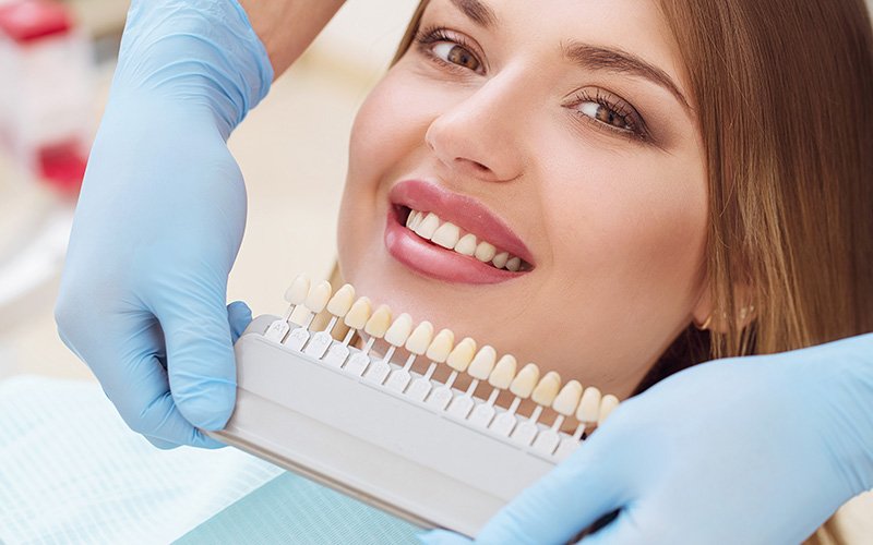 Veneers